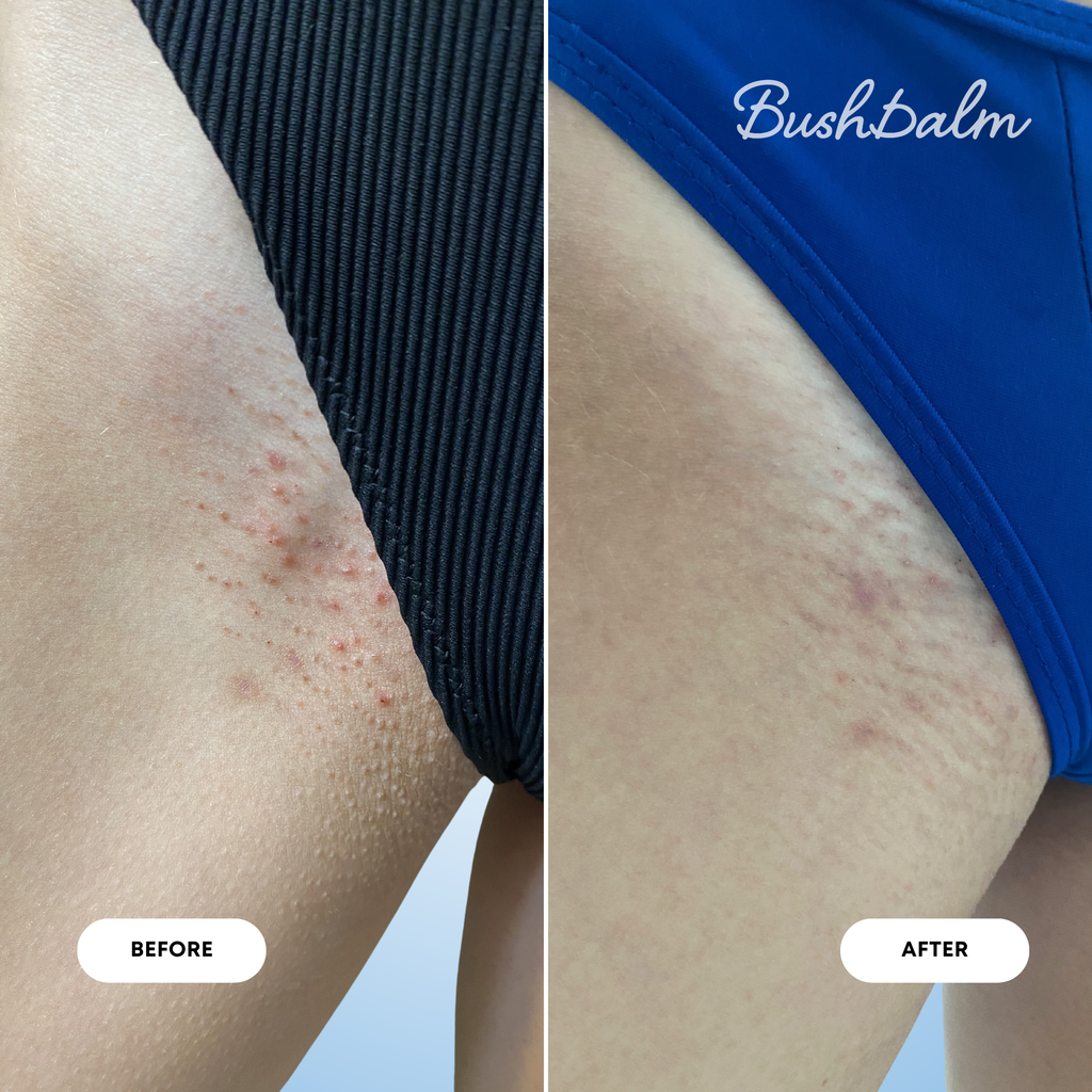 2-Step Ingrown Hair Routine - Nude V3