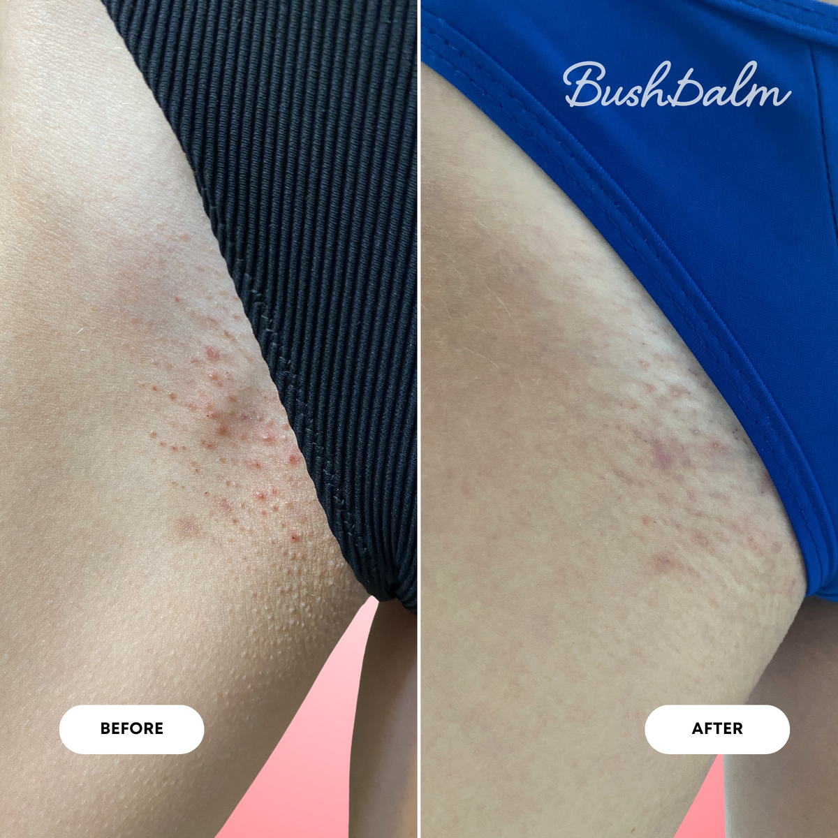 2-Step Ingrown Hair Routine - Watermelon Sugar B3