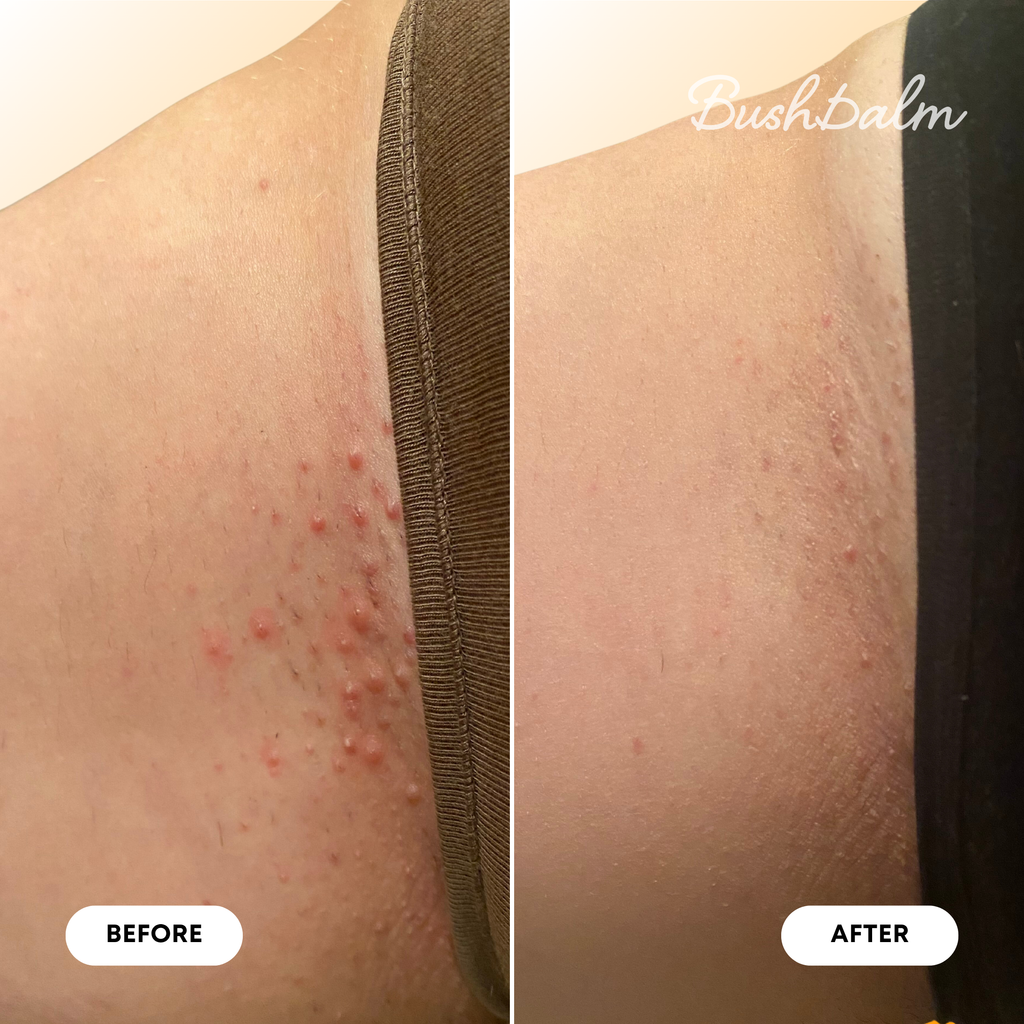 Mini Ingrown Hair Oil - Vanilla Tangerine Y1