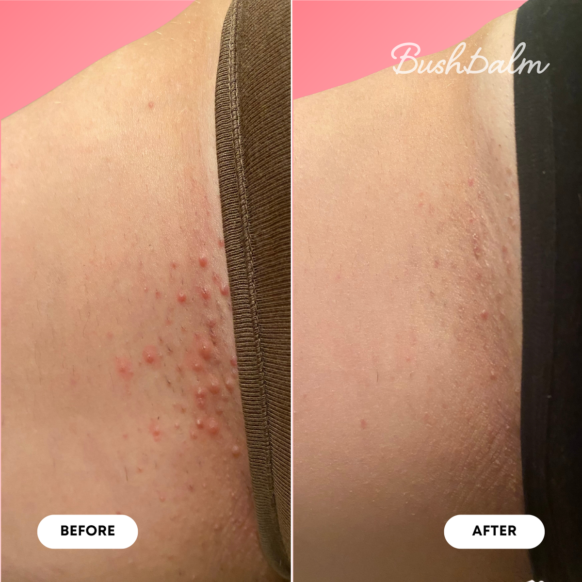 Mini Ingrown Hair Oil - Watermelon Sugar A7